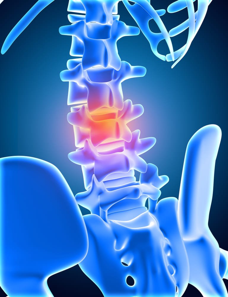 <strong>Cirugía de hernia de disco</strong>: tecnología avanzada para tu bienestar